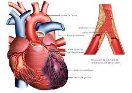 Infarctus du myocarde