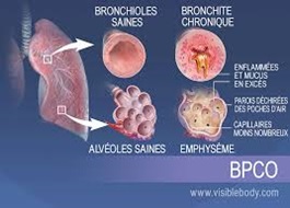 Bronchopneumopathie chronique obstructive (BPCO)
