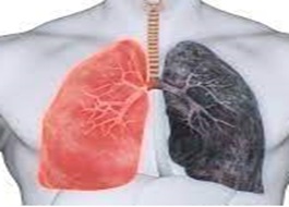 Emphysème pulmonaire